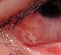 アレルギー結膜炎の所見